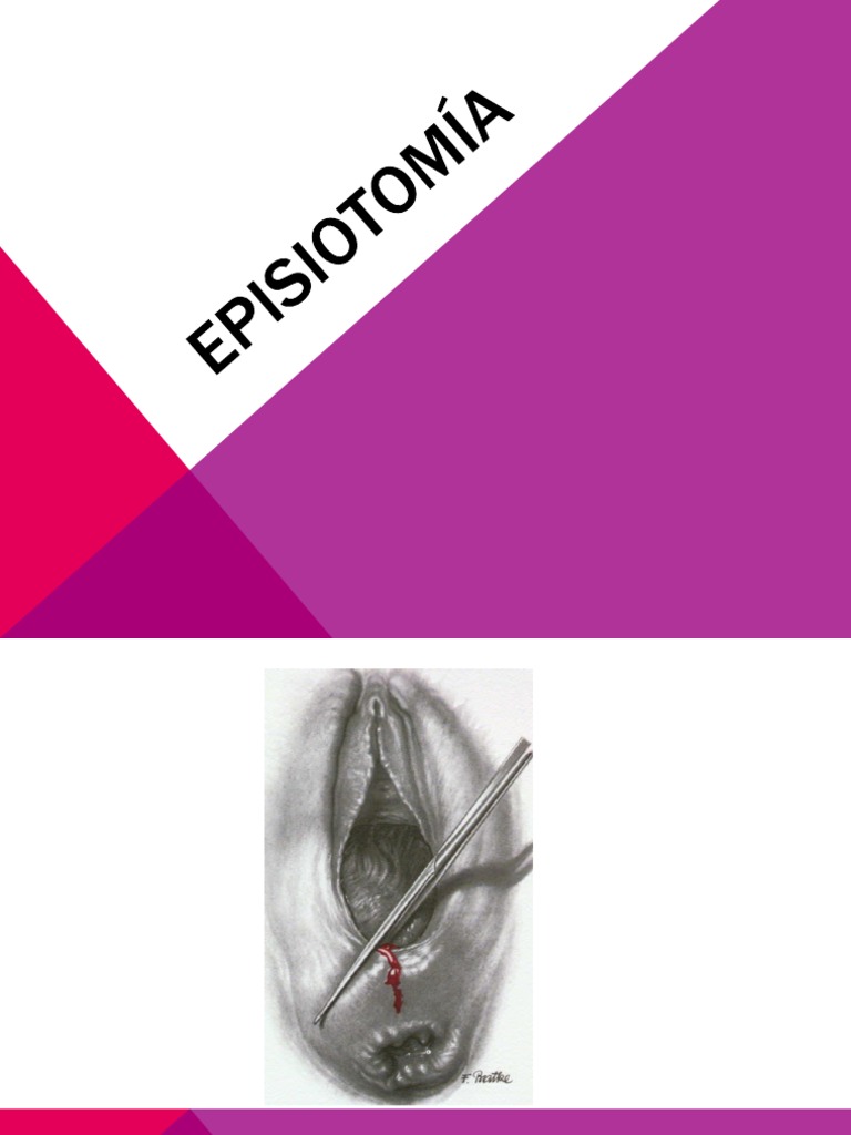 EPISIOTOMÍA | PDF | Vagina | Parto