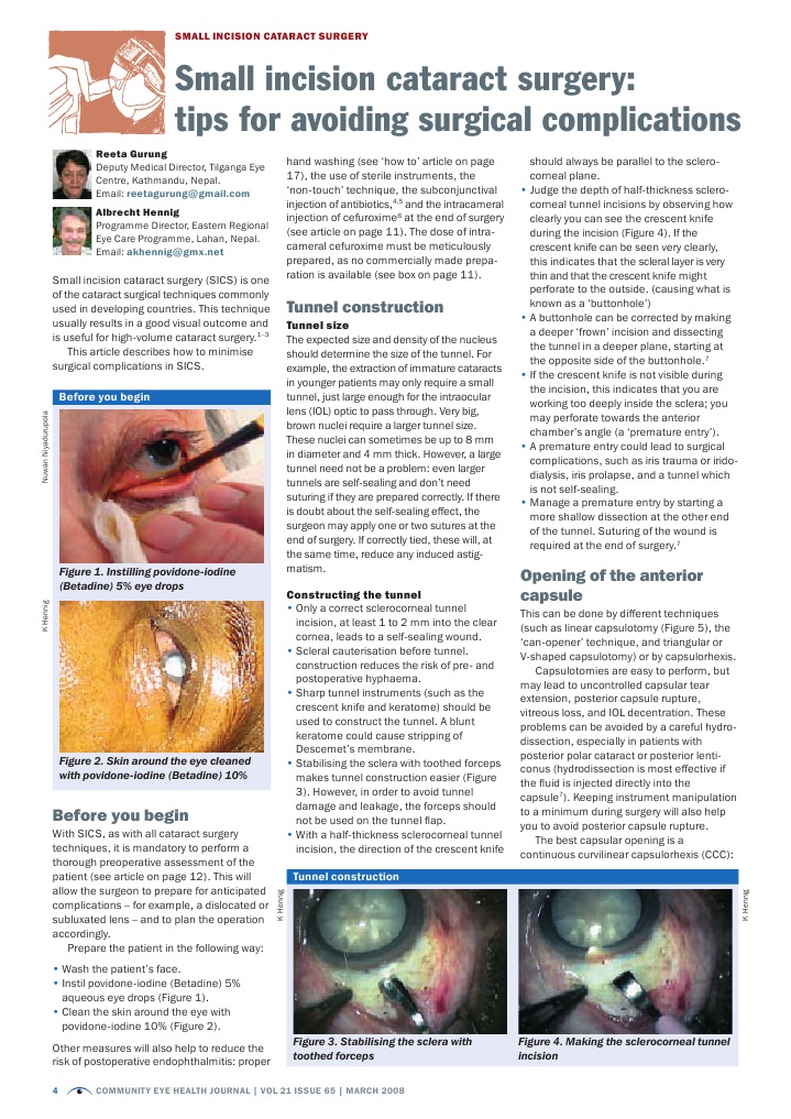 Small Incision Cataract Surgery (SICS) | PDF