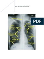 How To Read Chest X-Ray
