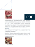 Causas de La Caries