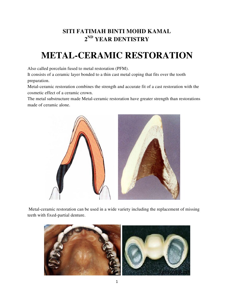 Metal Ceramic Restoration PDF Mouth Dentistry
