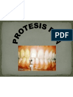 Protesis Fija