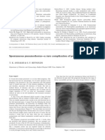 Spontaneous Pneumothorax-A Rare Complication of Pregnancy: 80 Obstetric Case Reports