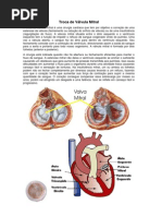 Troca de Válvula Mitral