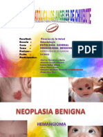 Neoplasia Benigna - Hemangioma