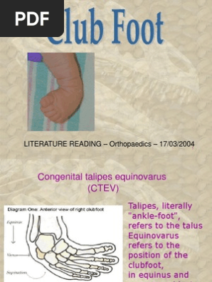 Club Foot Foot Orthopedic Surgery