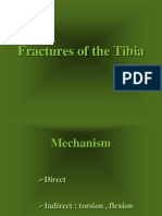 Fractures of The Tibia