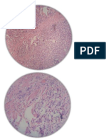 Carcinoma Ductal Infiltrante