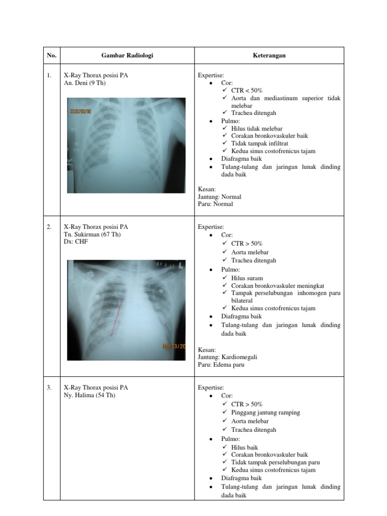 Hasil Rontgen Thorax pada Berbagai Kasus | PDF