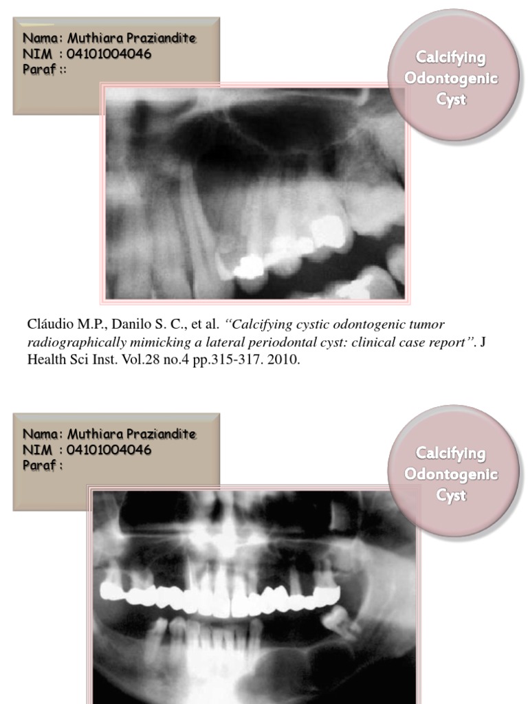 Calcifying Odontogenic Cyst Radiograph