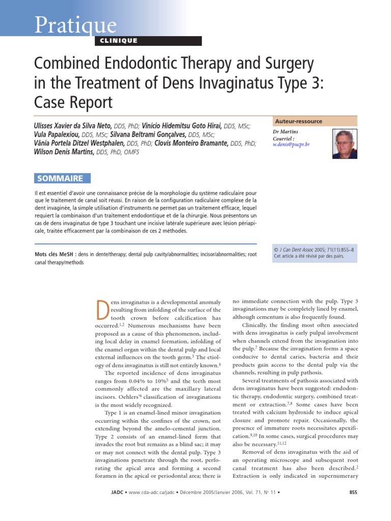 Dens Invaginate.. | Surgery | Health Care