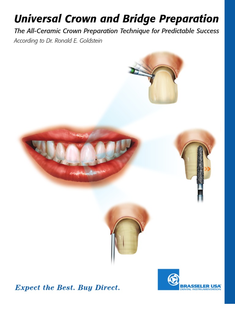 Universal Crown and Bridge Preparation PDF