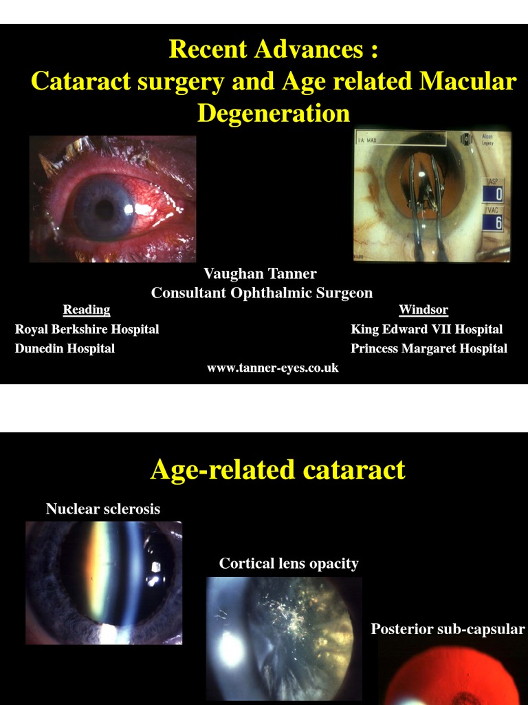 Cataract Surgery and Age Related Macular Degeneration