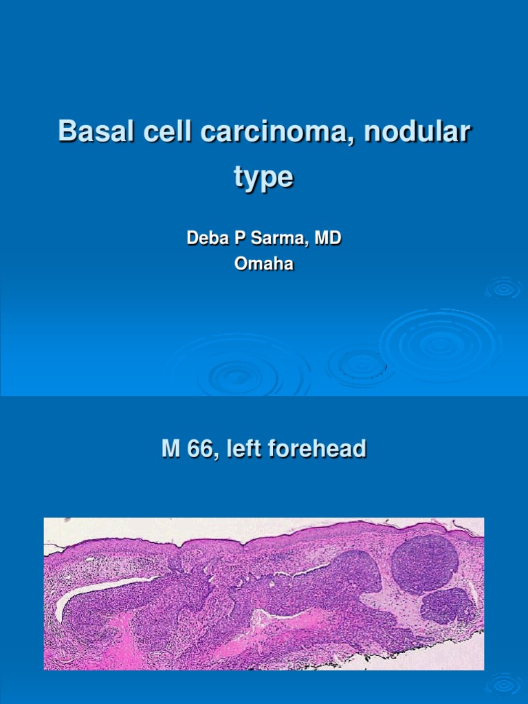 Basal Cell Carcinoma, Nodular Type. M 66, Forehead PDF