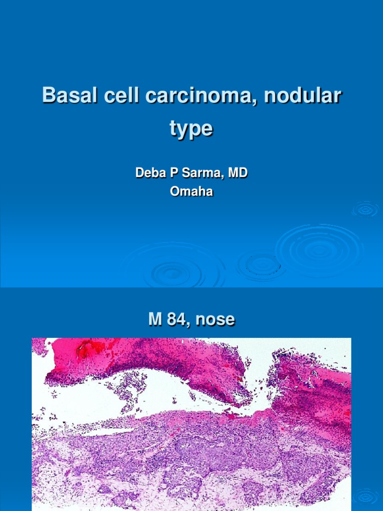 Basal Cell Carcinoma, Nodular Type. M 84, Nose PDF