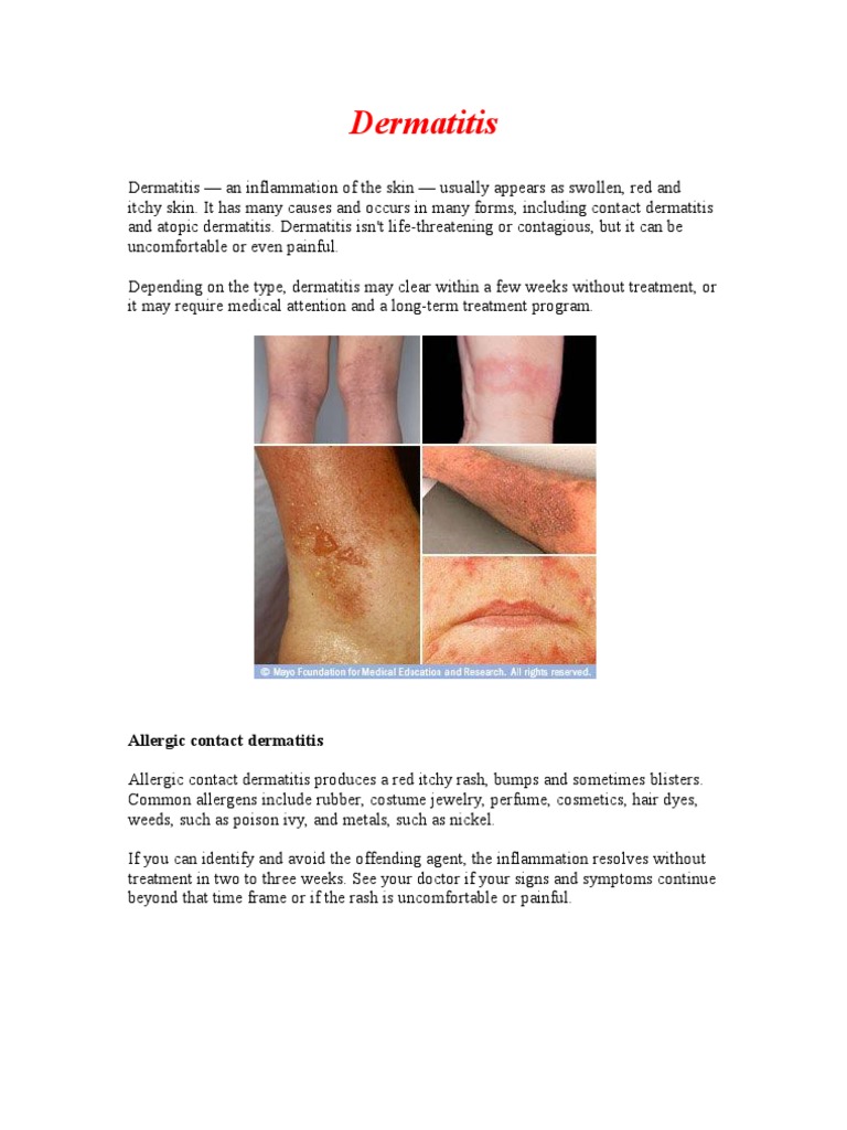 Dermatitis | PDF | Dermatitis | Rtt