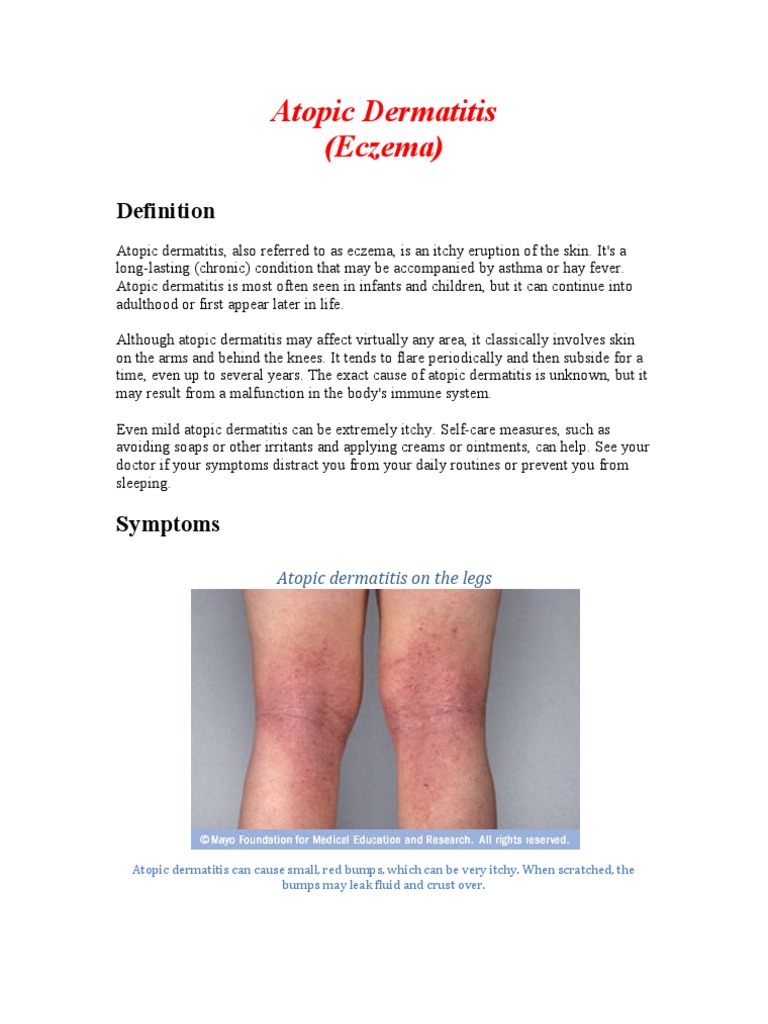 Eczema Dermatitis Dermatology