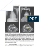 A Primera Vista 81 (Derrame Pericárdico Maligno)