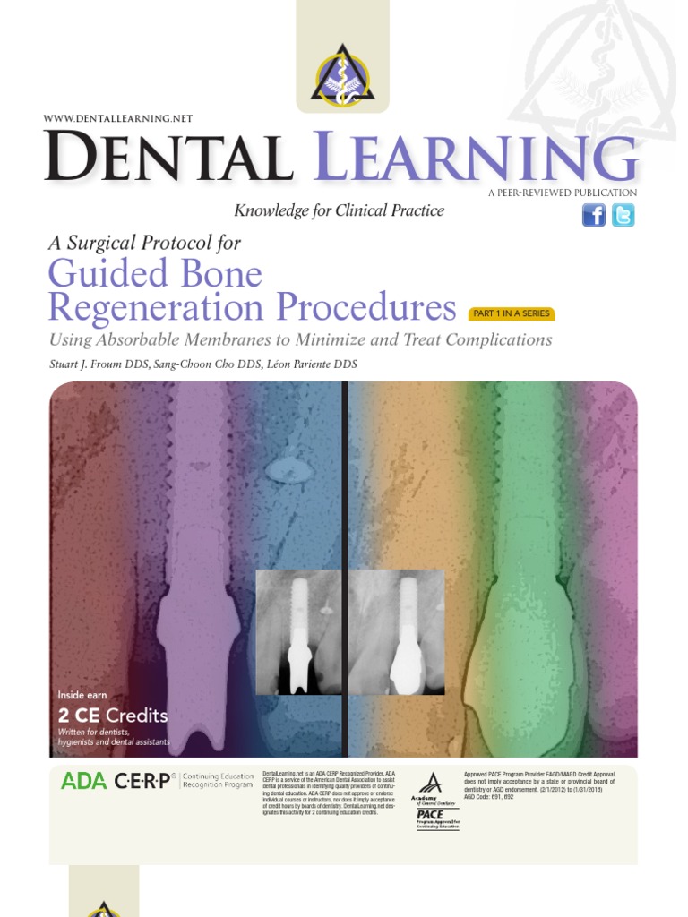 Guided Bone Regeneration Procedure | PDF | Dental Implant | Surgical Suture
