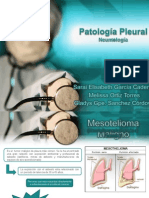 Mesotelioma - Neumología