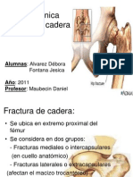 Biomecánica Fractura de Cadera