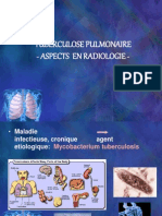 Tuberculose Pulmonaire-Aspects Radiologiques