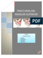 Fracturas Del Maxilar Superior