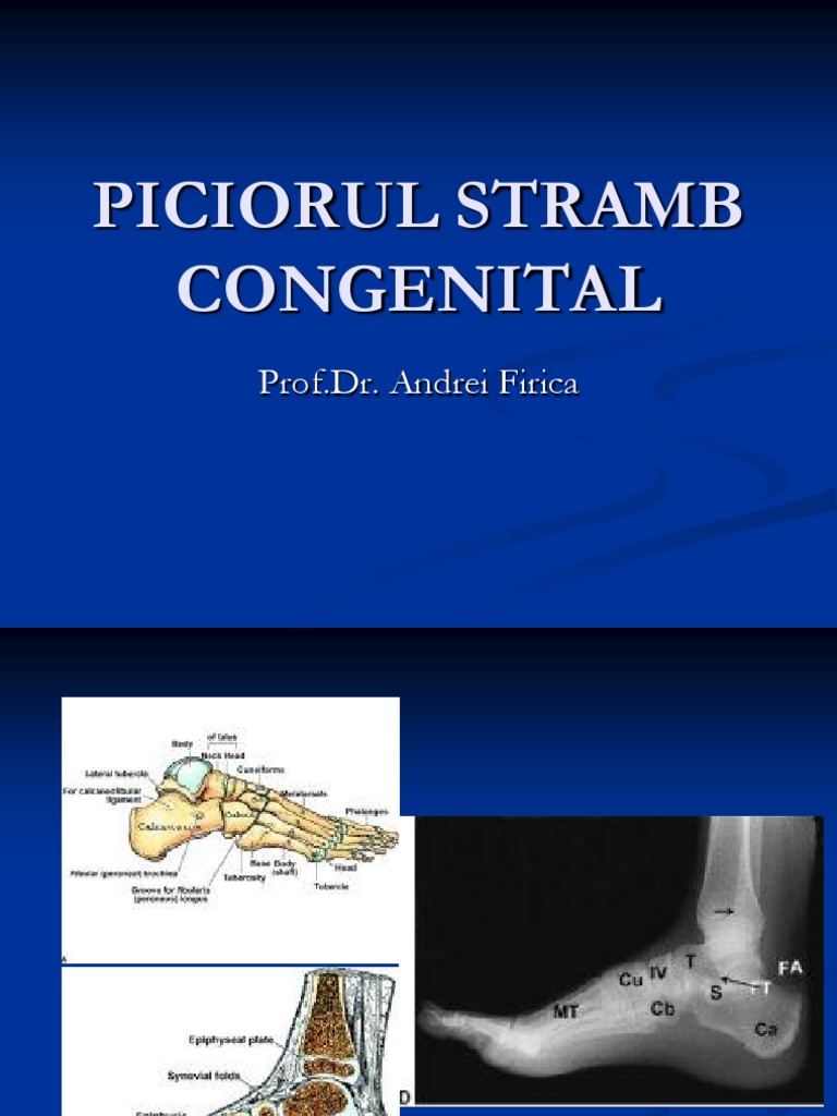 Piciorul Stramb Congenital | PDF