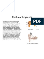 Cochlear Implants