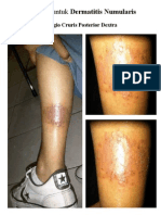 Dermatitis Numularis