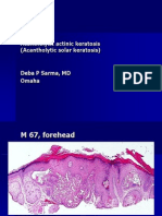 Acantholytic Actinic Keratosis, M 67, Forehead