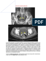 A Primera Vista 98 (Calcificación de Los Conductos Deferentes)
