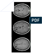 Brain Tumor (Post Surgery) Slight Resurgence