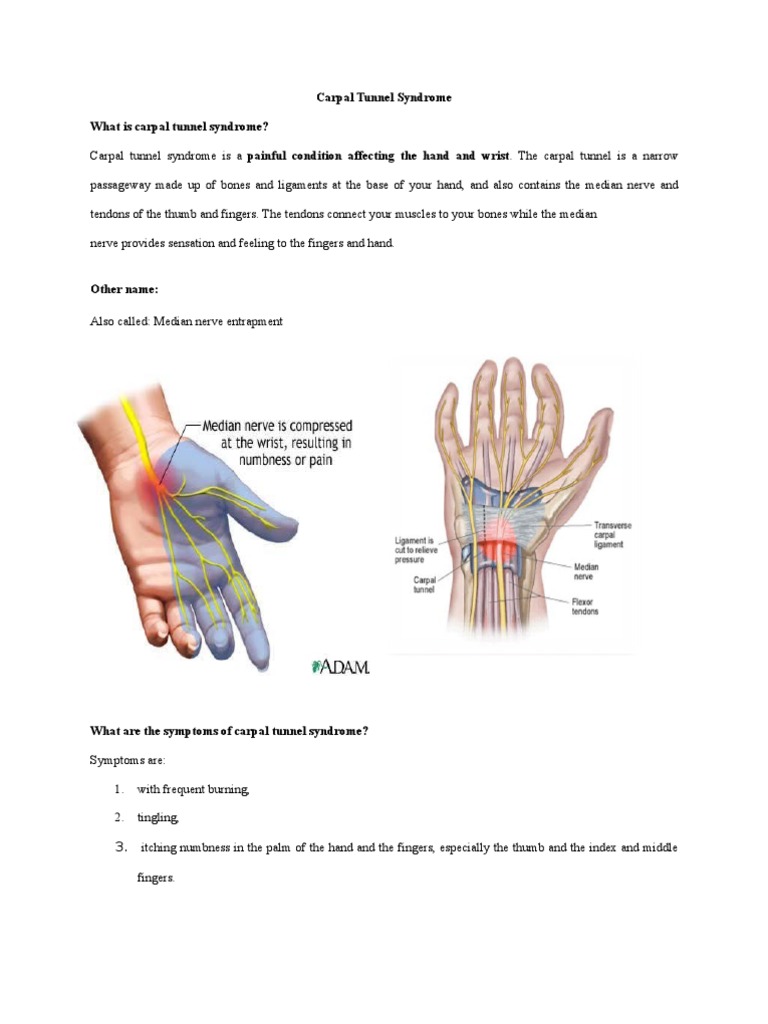 Understanding Carpal Tunnel Syndrome | PDF | Carpal Tunnel Syndrome | Hand