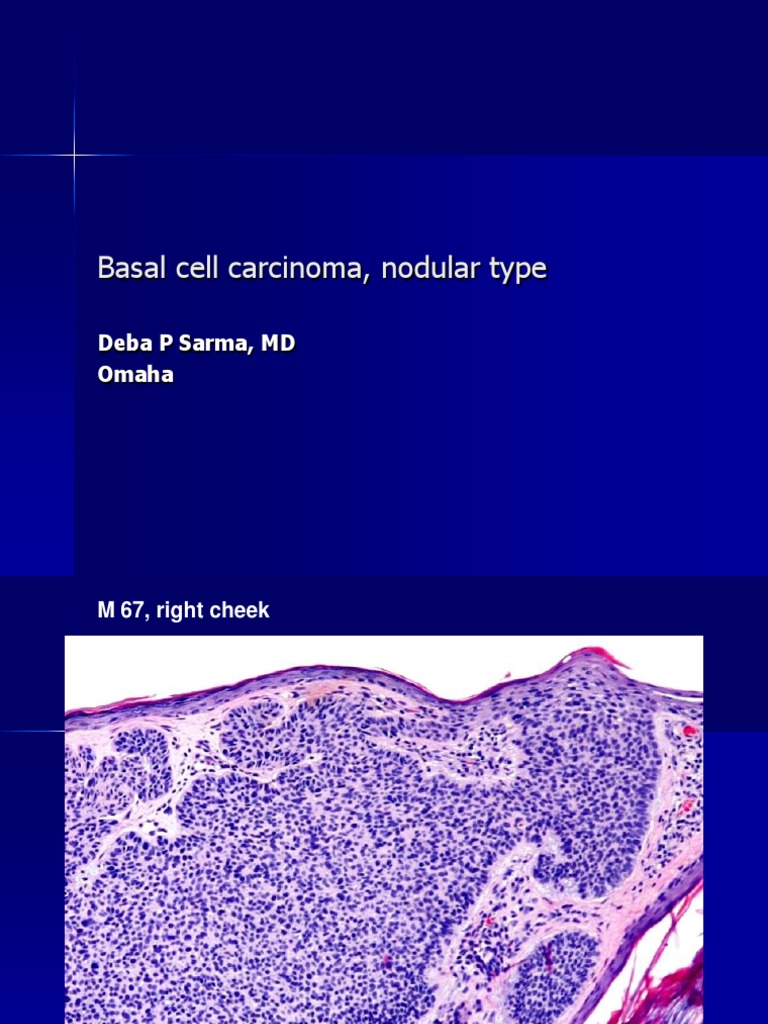 Basal Cell Carcinoma, Nodular Type., M 67, Right Cheek PDF