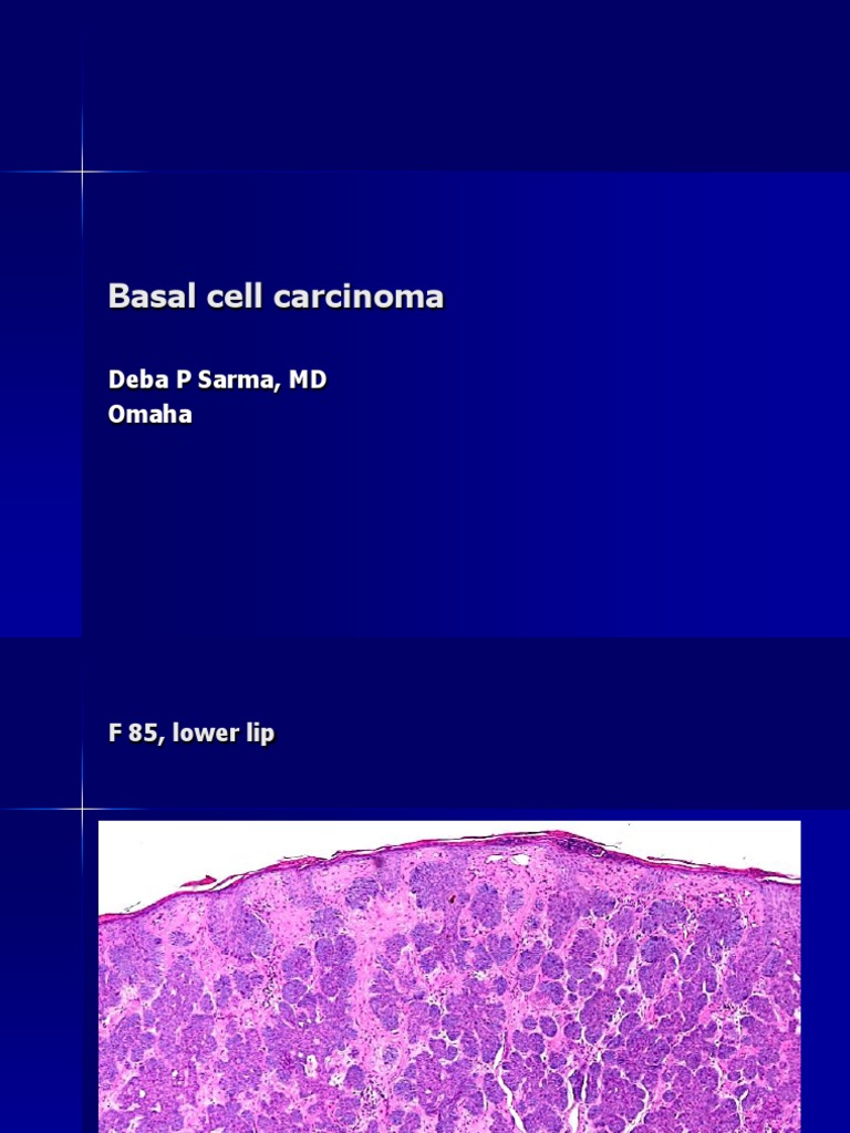 Basal Cell Carcinoma | PDF