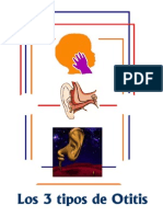 Los 3 Tipos de Otitis