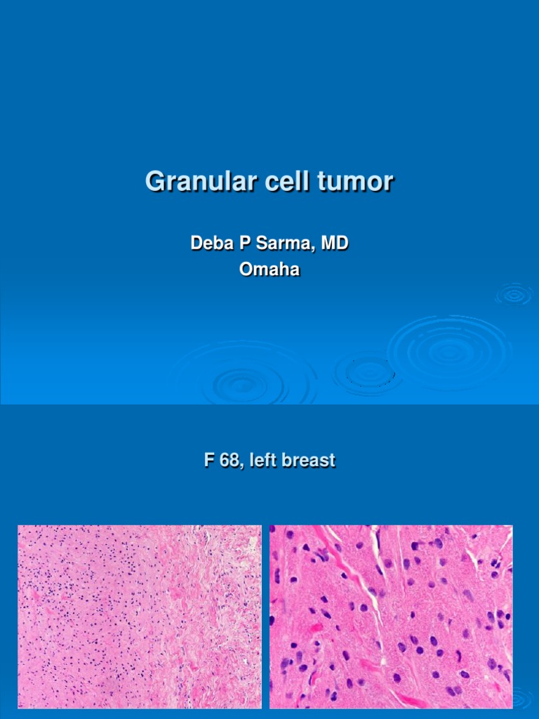 Granular Cell Tumor, F 68, Left Breast | PDF