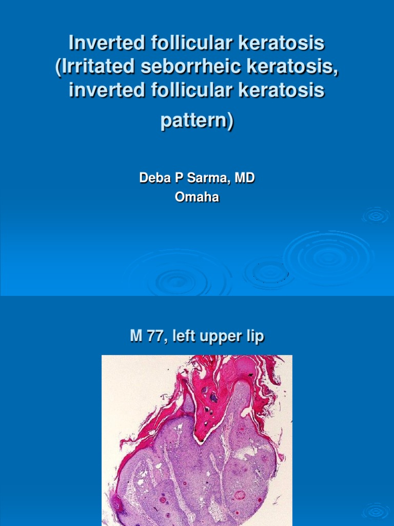 Inverted Follicular Keratosi Irritated Seborrheic Keratosis, Inverted ...