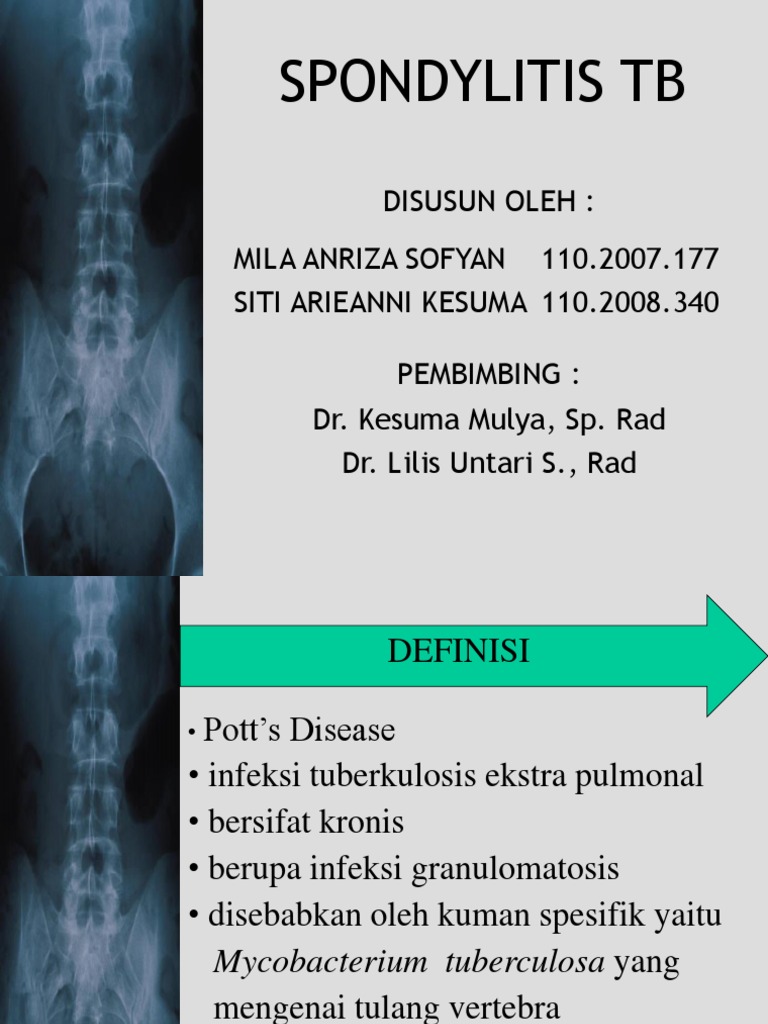 Spondylitis Tuberkulosa: Diagnosis dan Terapi | PDF | Ilmu Sosial