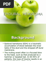 Epidural Hematoma