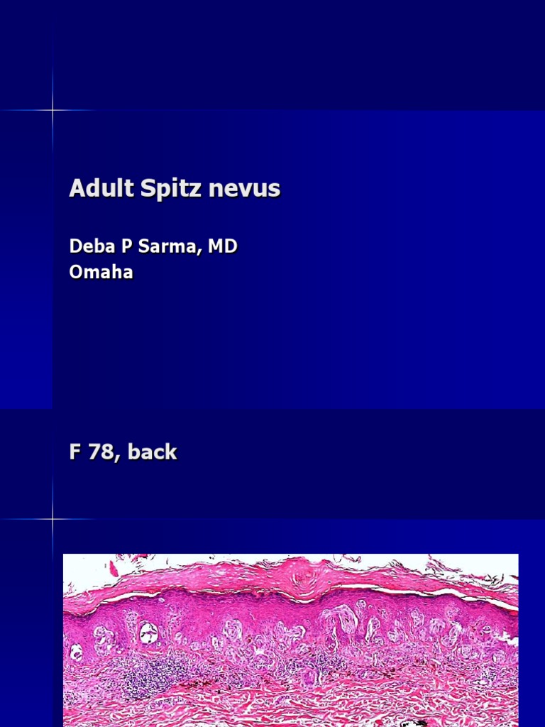 Adult Spitz Nevus Case Study | PDF