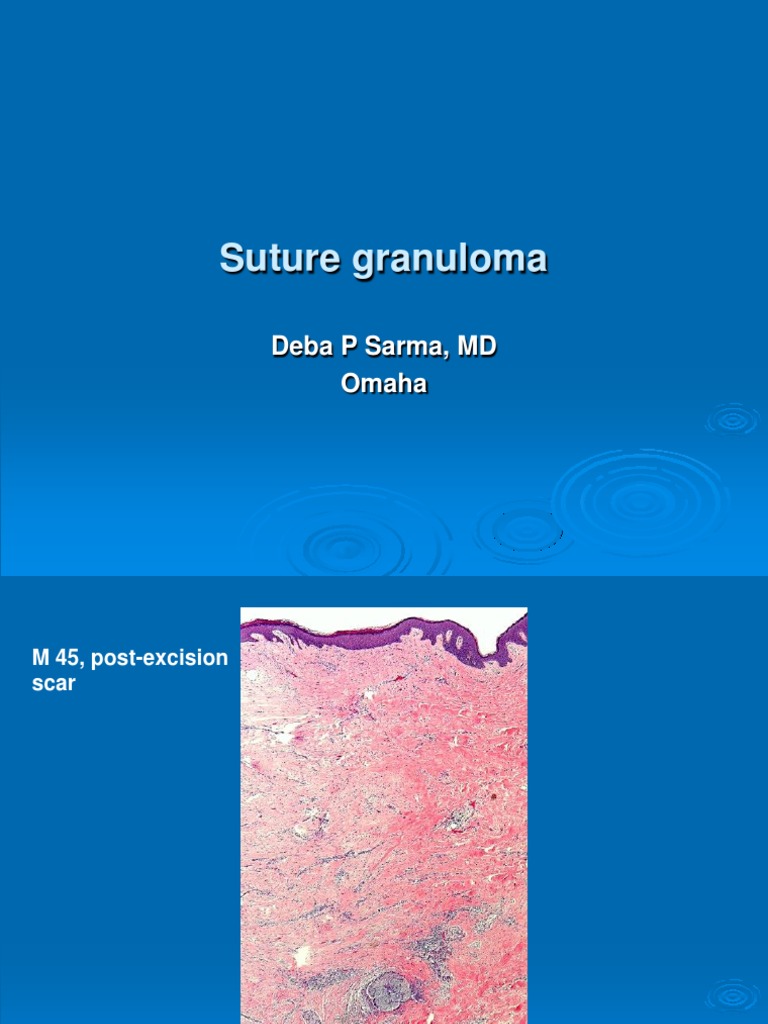 Suture Granuloma PDF