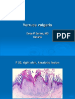 Verruca Vulgaris., F52, Right Shin, PPT