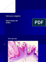 Verruca Vulgaris., M 22.,PPT