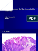 Vulvar Squamous Cell Carcinoma In-Situ (VIN III), F 50, Vulva