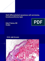 Well Differentiated Squamous Cell Carcinoma,KA Type, M 80, Right Forearm. PPT