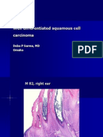 Well Differentiated Squamous Cell Carcinoma. M 82,Right Ear. PPT