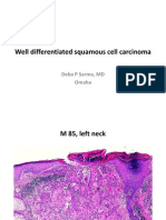 Well Differentiated Squamous Cell Carcinoma. M 85, Left Neck.