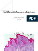 Well Differentiated Squamous Cell Carcinoma